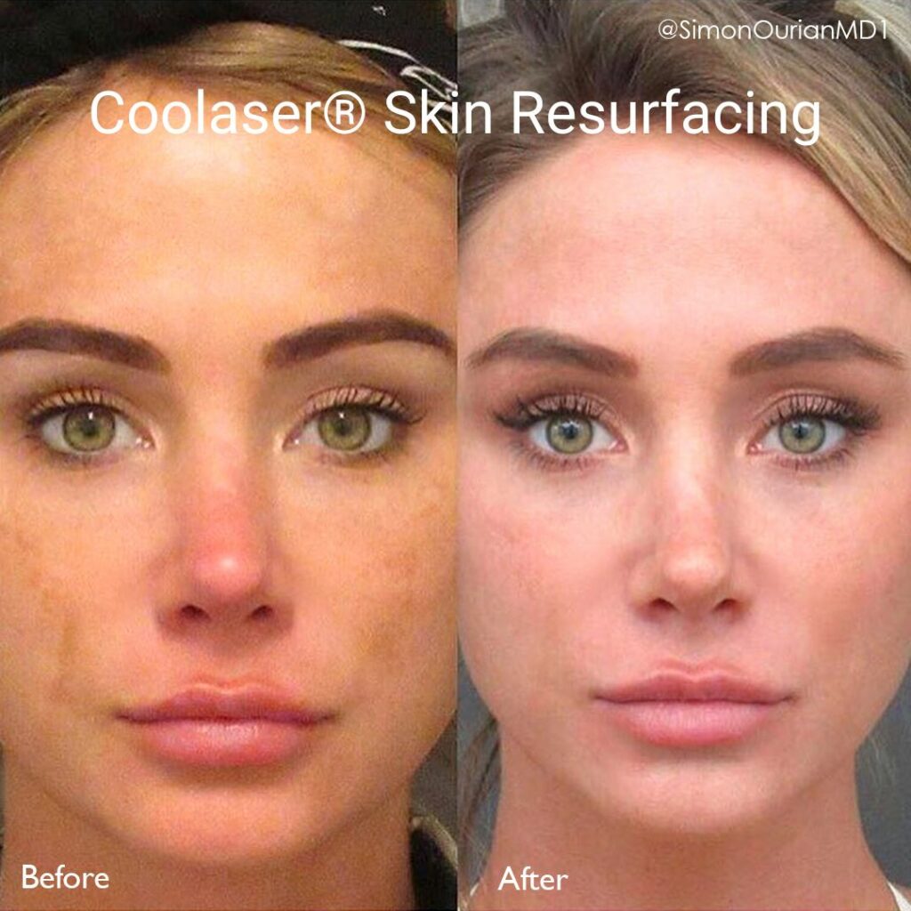 Side by side before and after photo of a woman who has had skin resurfacing