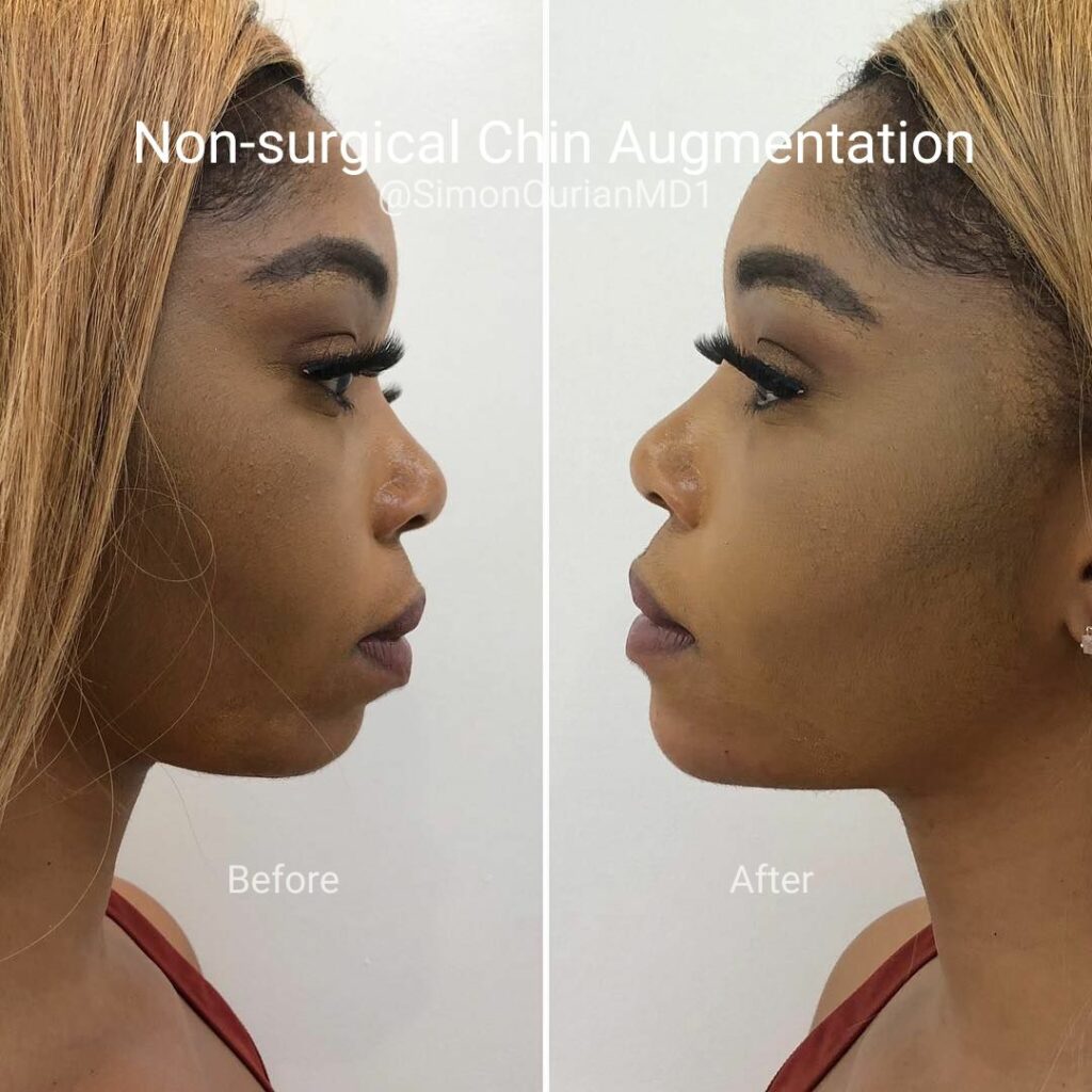 Side by side before and after photo of a woman who has had chin augmentation